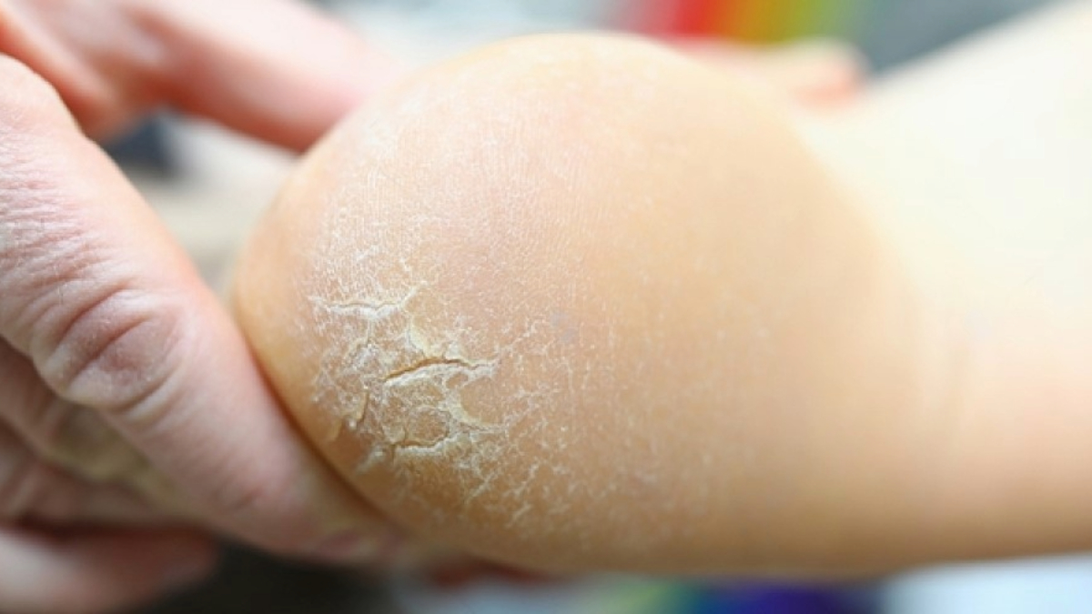 Enhancing Foot Care: Home Remedies for Cracked Heels to Boost Your Product Offerings Enhancing Foot Care: Home Remedies for Cracked Heels to Boost Your Product Offerings