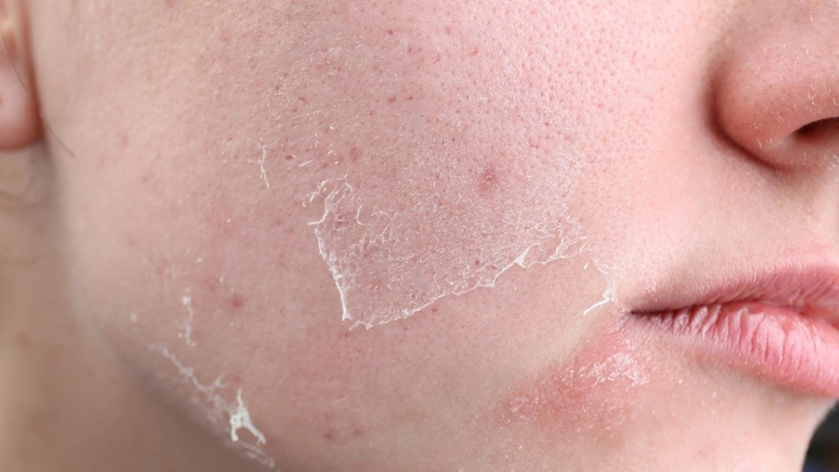 Natural Remedies for Dry Skin: How Consumers Are Leading the Shift Towards Gentle Skincare