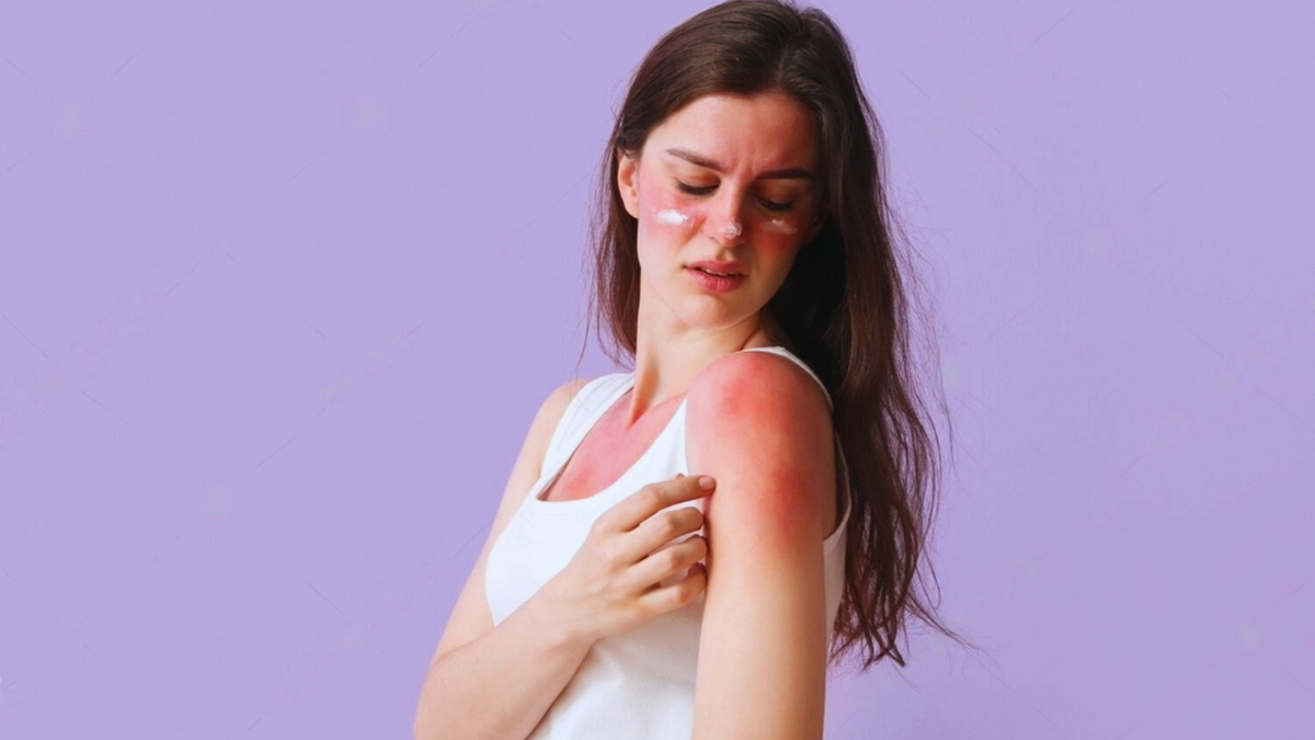 Nature’s Cure for Sunburn: 8 Unexpected Sunburn Remedies That Could Shape Tomorrow's Skincare Nature’s Cure for Sunburn: 8 Unexpected Sunburn Remedies That Could Shape Tomorrow's Skincare