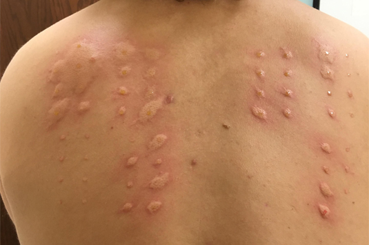 Allergen Testing from Dr Parthiv Shah
