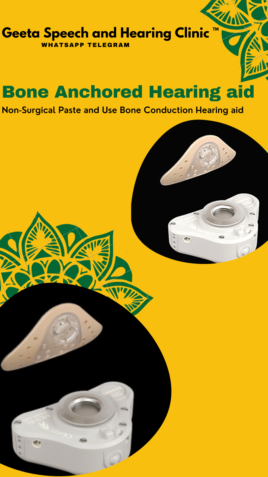 Bone anchored Hearing aid