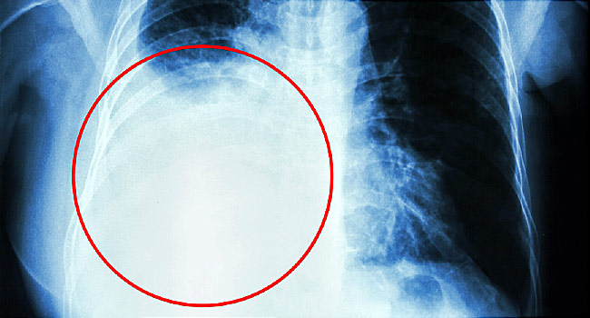 Pleural Diseases Treatment from Dr Parthiv Shah