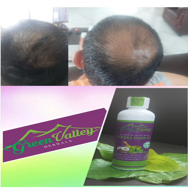 Authentic Hand Made Herbal Hair Oil  Result . 2