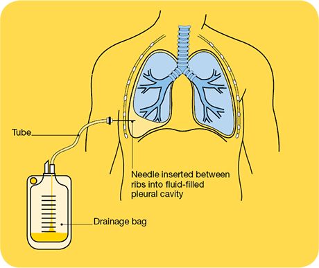 Chest Tube Thoracostomy from Dr Parthiv Shah