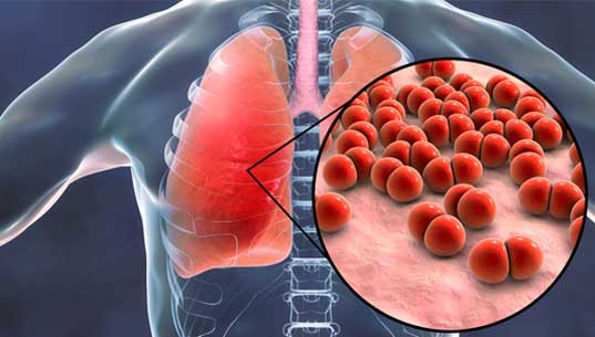 Pneumonia Treatment  from Dr Parthiv Shah