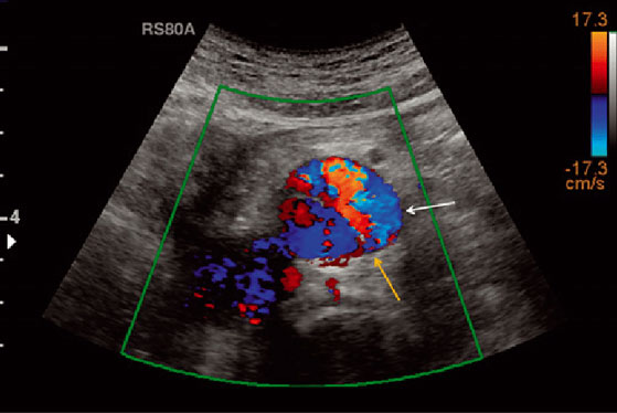 Colour Doppler from Dr. Panchal Lab and Diagnostics Centre